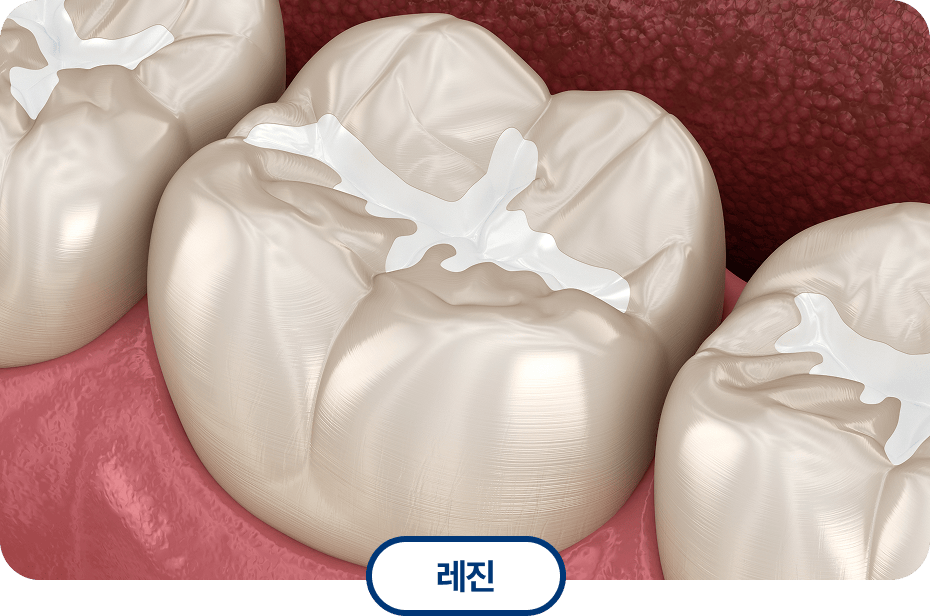 레진