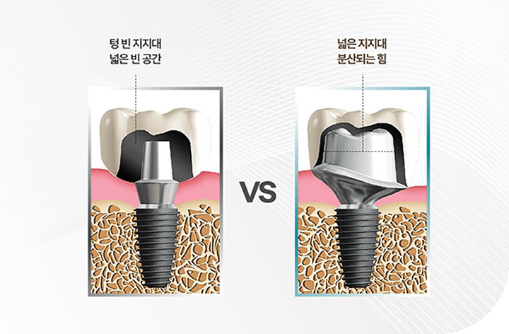 환자 맞춤형 지대주 사용