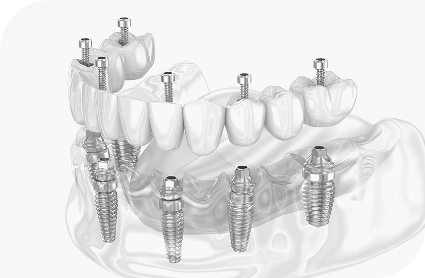 전체 임플란트