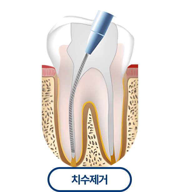 치수제거
