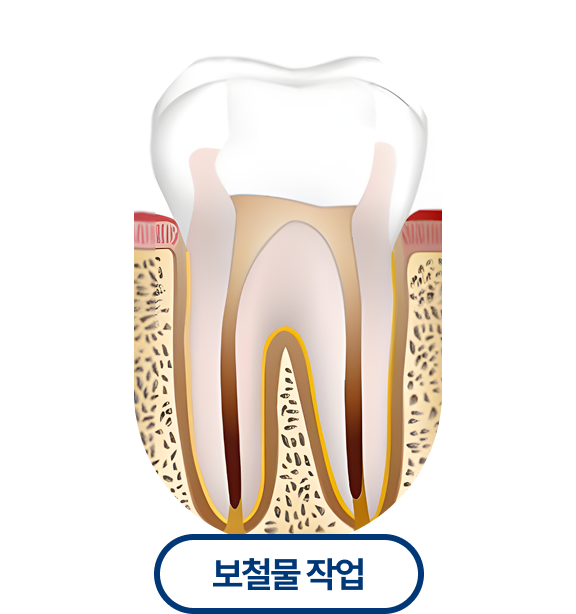보철물작업