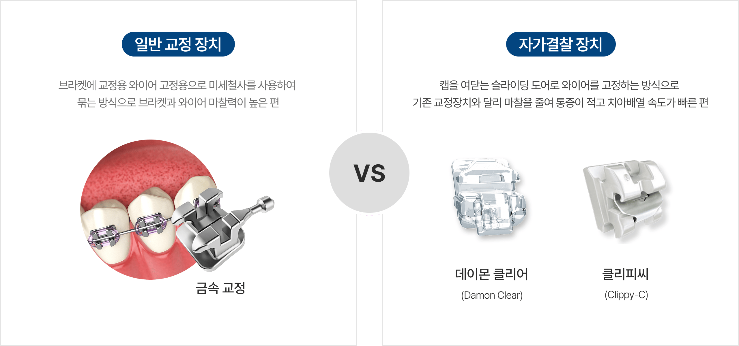 일반교정장치와 자가결찰장치의 차이